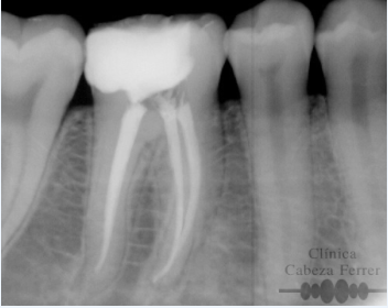 Caso 3: rehabilitación endodóntica en molar con restauración posterior. Después