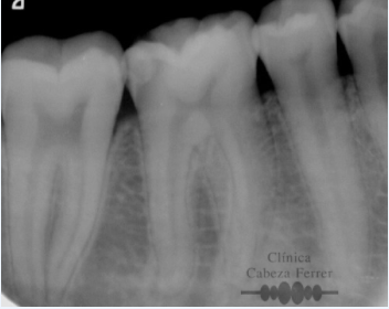 Caso 3: rehabilitación endodóntica en molar con restauración posterior. Antes