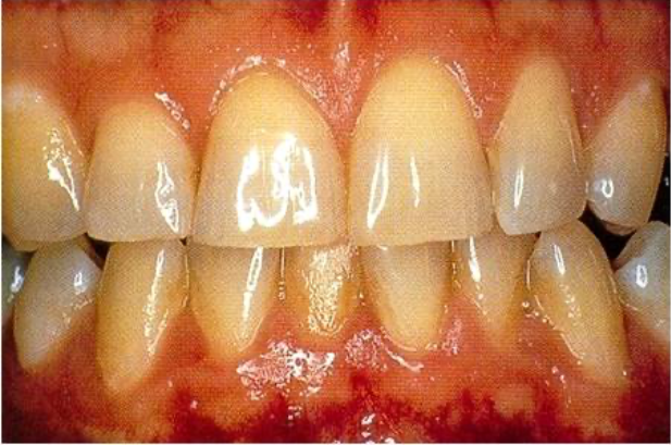 Blanqueamiento dental: antes.