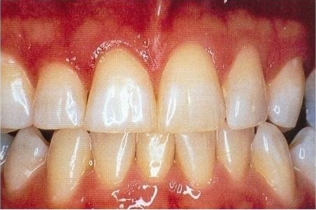 Blanqueamiento dental: después.