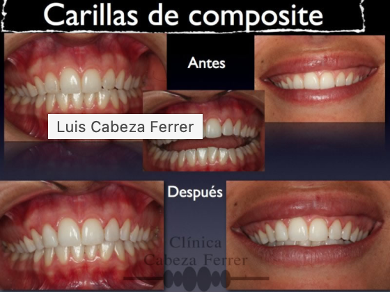 Carillas de composite: antes y después.