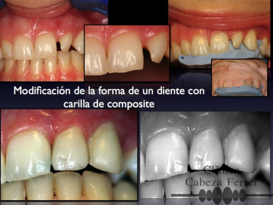 Modificación de la forma de un diente con carilla de composite.