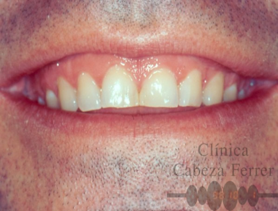 Línea de la sonrisa invertida por desgaste del borde incisal.