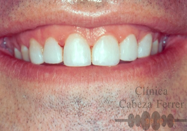 Borde incisal restaurado siguiendo la curvatura natural de la sonrisa.