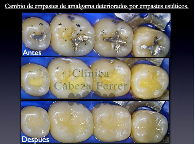 Cambio de empastes de amalgama deteriorados por empastes estéticos.