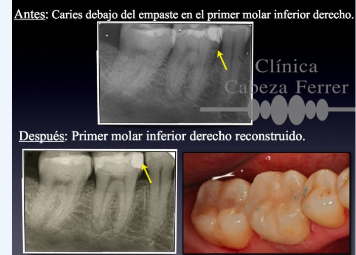 Antes: caries debajo del empaste en el primer molar inferior derecho. Después: primer molar inferior derecho reconstruido.