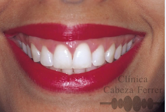 Sonrisa de paciente del sexo femenino, de 27 años de edad.