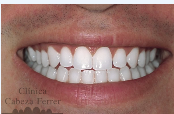 Sonrisa de paciente del sexo masculino, de 26 años de edad.