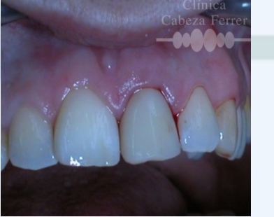Remodelación del contorno gingival con una prótesis provisional.