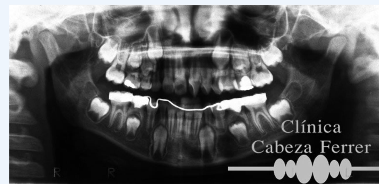Radiografía panorámica infantil para valorar el desarrollo dental y la erupción de los dientes definitivos.