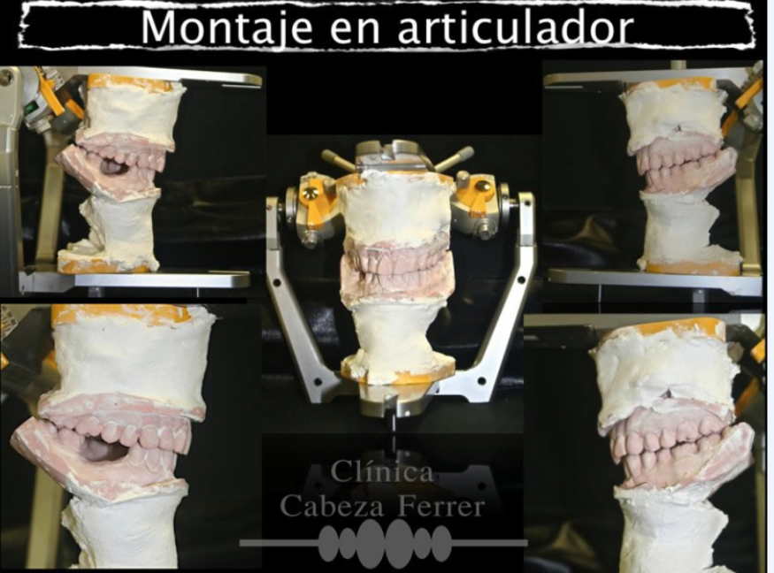 Montaje en articulador para estudiar la oclusión y la articulación temporomandibular.