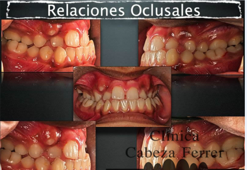 Relaciones oclusales para valorar la mordida y la función mandibular.
