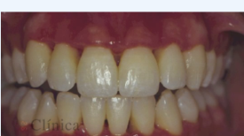 Paciente portadora de gingivitis ulcerativa necrosante.