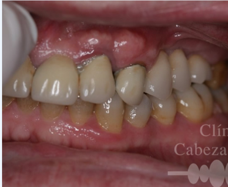 Ejemplo clínico de inflamación periodontal y afectación de las encías alrededor de los dientes.