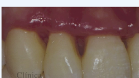 Detalle de la papila gingival dos semanas después de la fase aguda.