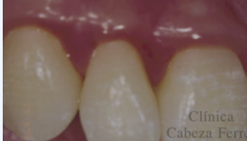Detalle de la papila gingival después de dos años.