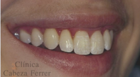 Sonrisa con exposición de las papilas gingivales neoformadas tres meses después de la fase aguda.