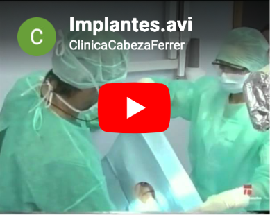 Implantes